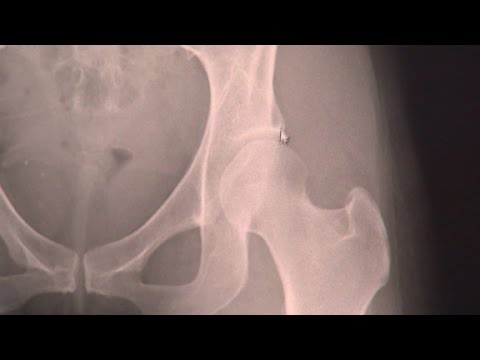 hip dysplasiasurgery